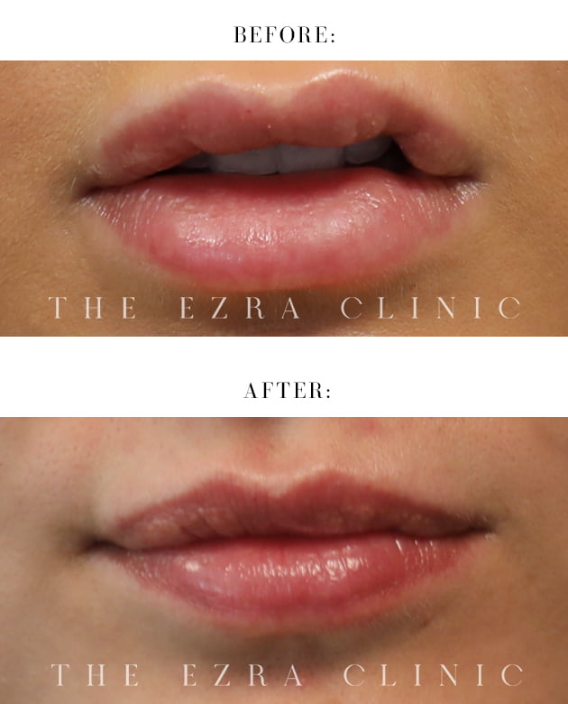 Before and after of filler dissolving treatment on the lips