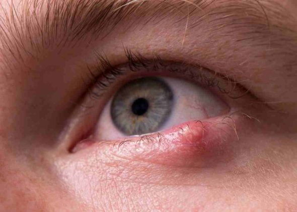 Example of a person with chalazion