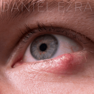 Chalazion example