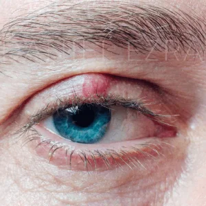 Example of Chalazion