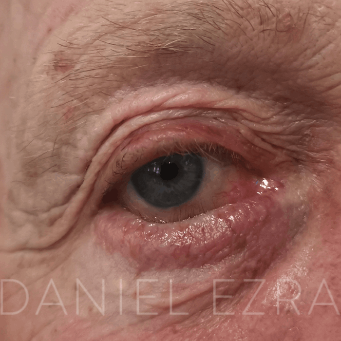 example of entropion