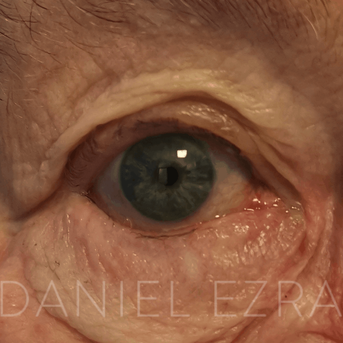 eyelid entropion