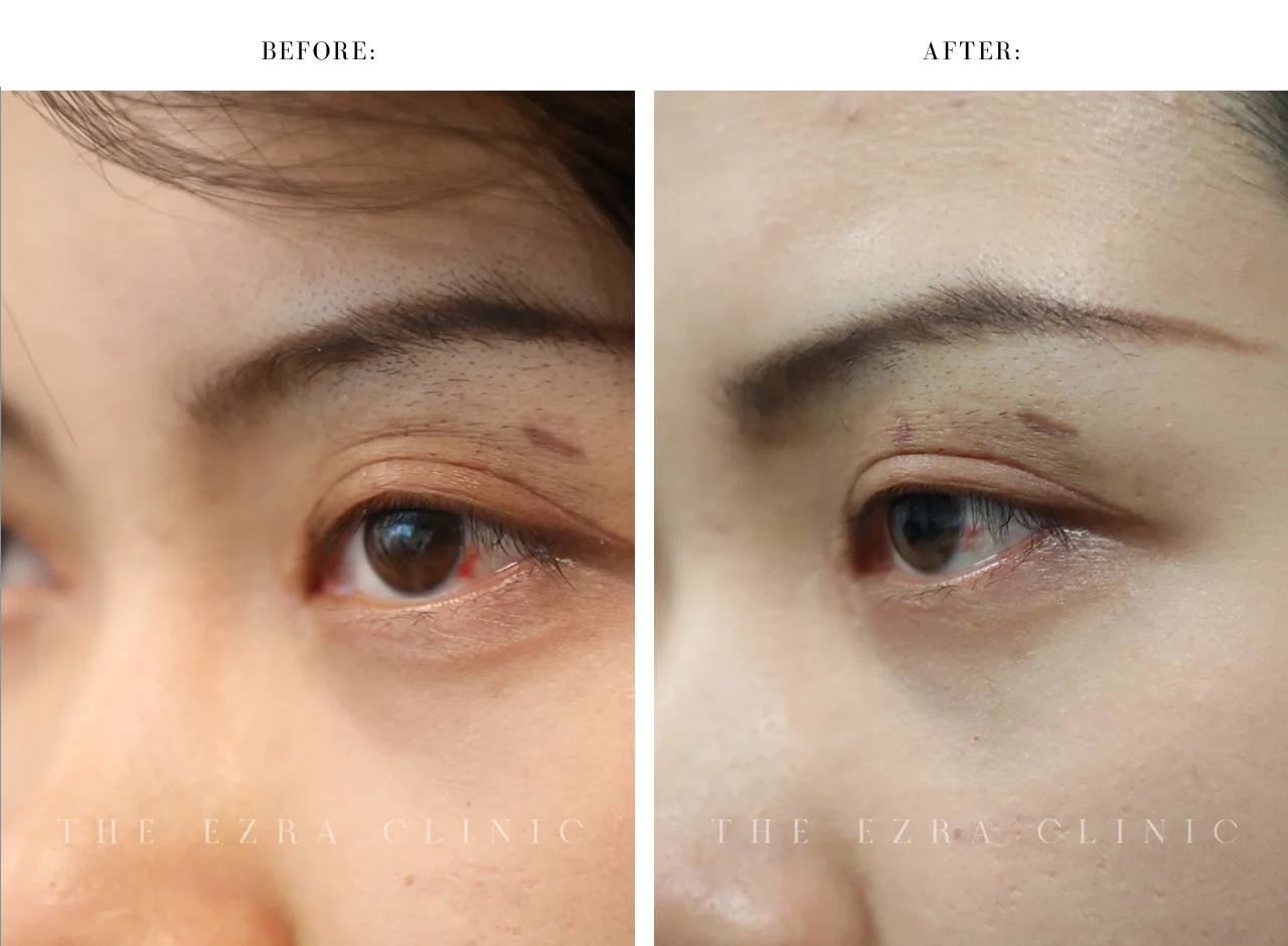 Revision blepharoplasty before and after
