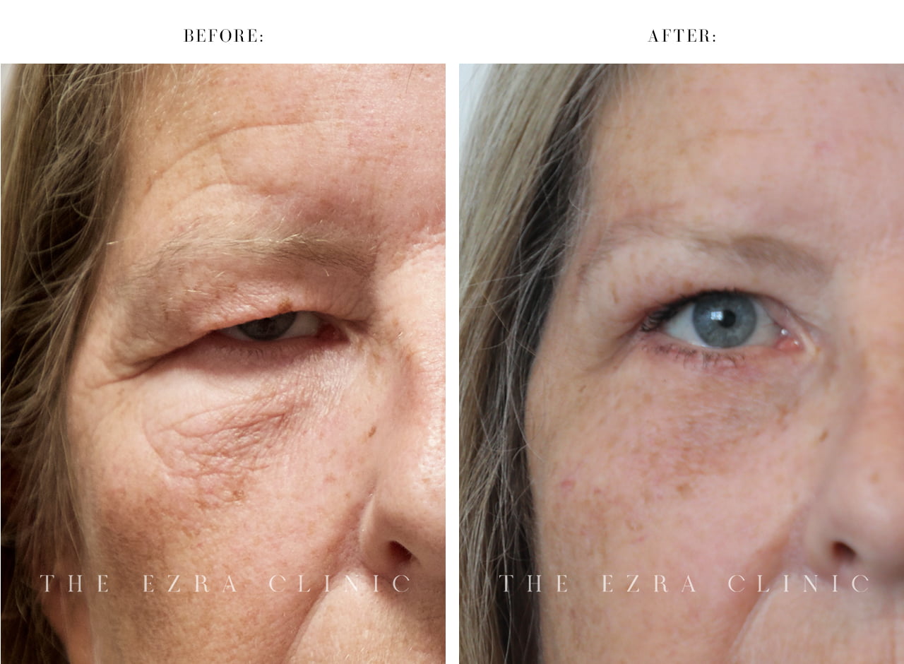 white woman before and after blepharoplasty and direct brow
