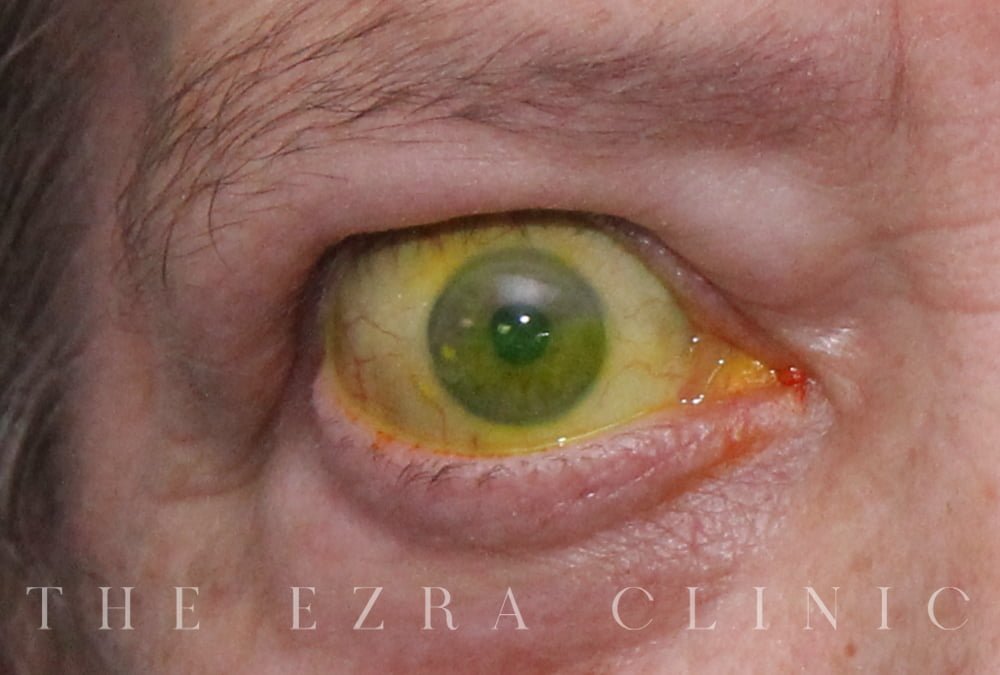 man with thyroid eye disease