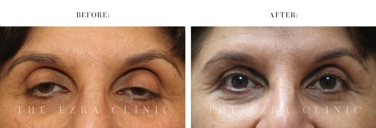 Before-After Ptosis Surgery