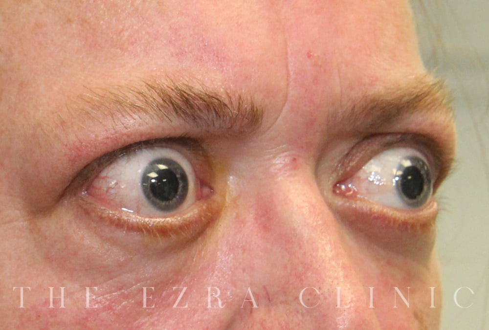 man with thyroid eye disease