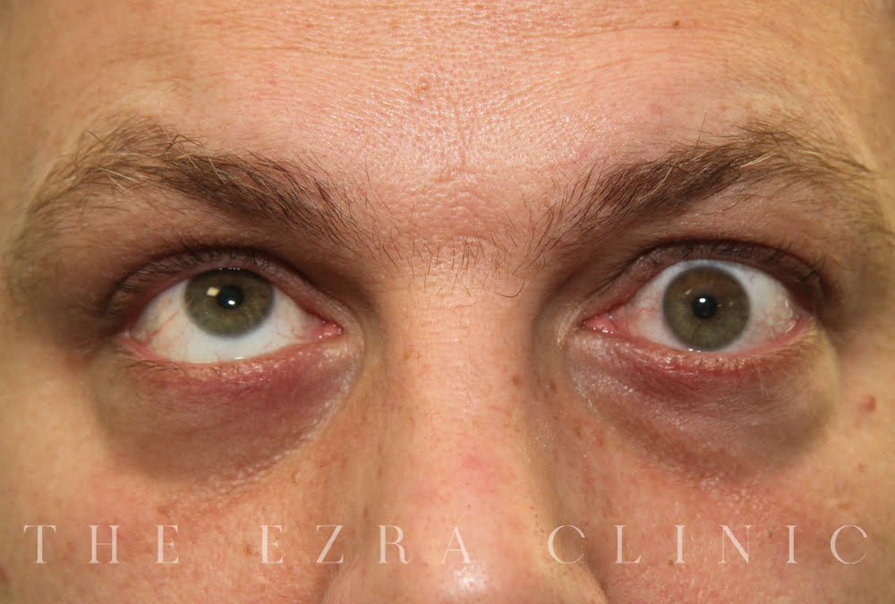 man with thyroid eye disease