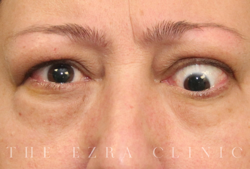 woman with thyroid eye disease