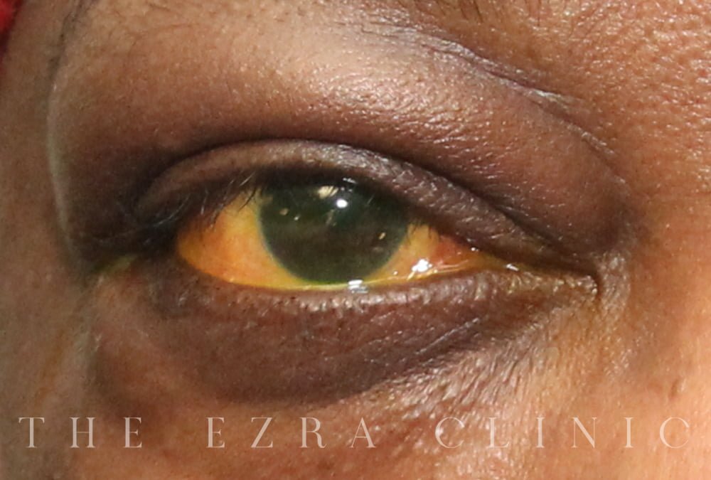 man with thyroid eye disease