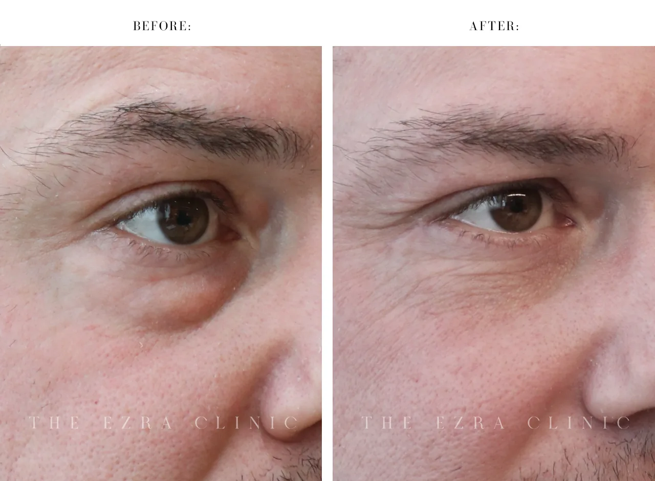 Before and after images of a man showing the results of preservation lower lid blepharoplasty with fat redistributed to fill hollows and a mid-face elevation creating a smooth transition between the lid and cheek.