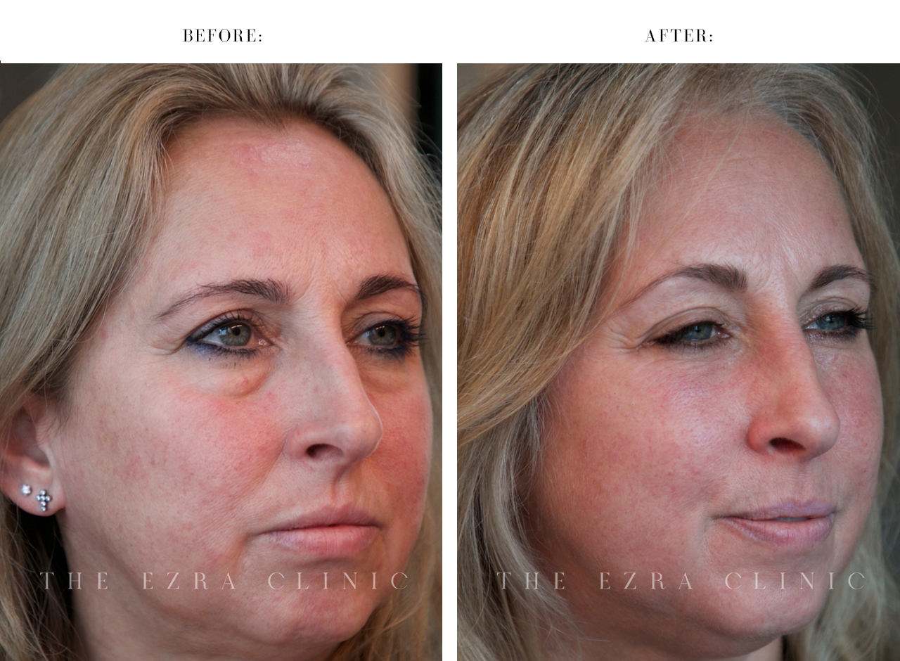 Before and after images of a woman's eyes showcasing the results of a bilateral lower lid blepharoplasty with mid-face lift, highlighting reduced under-eye bags and smoother skin.