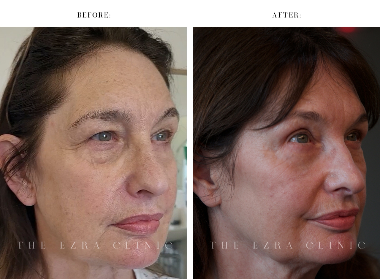 Before and after images of a woman highlighting the results of a lower lid fat repositioning, mid-face elevation, and direct brow lift. The procedure significantly opened the upper lid space and completely resolved lower lid bags, achieving a refreshed and rejuvenated appearance.
