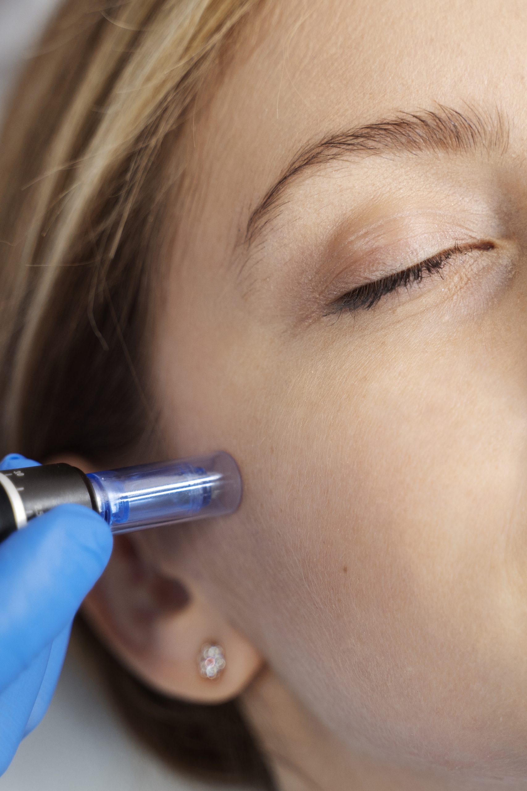 woman patient undergoing microneedling procedure