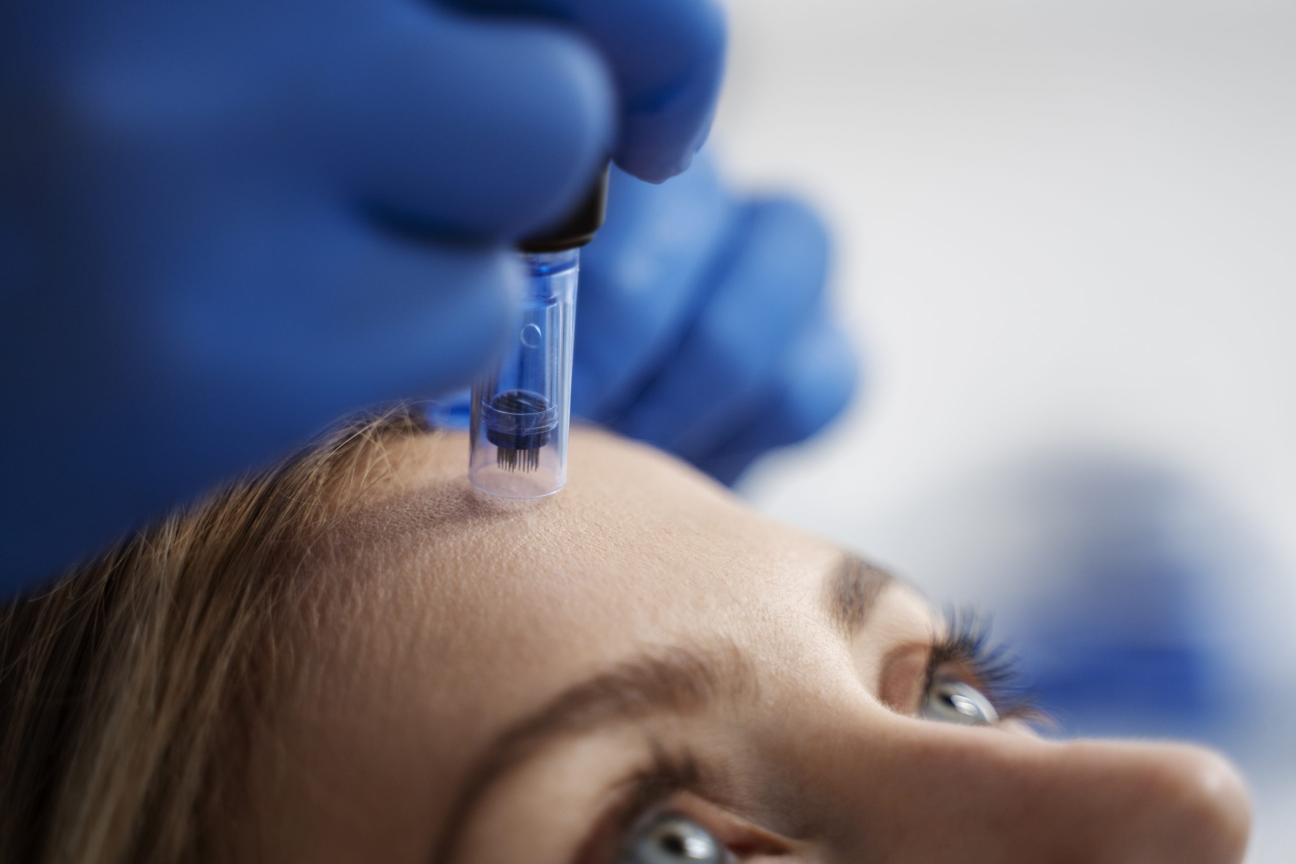 blonde, blue eyed patient undergoing microneedling procedure