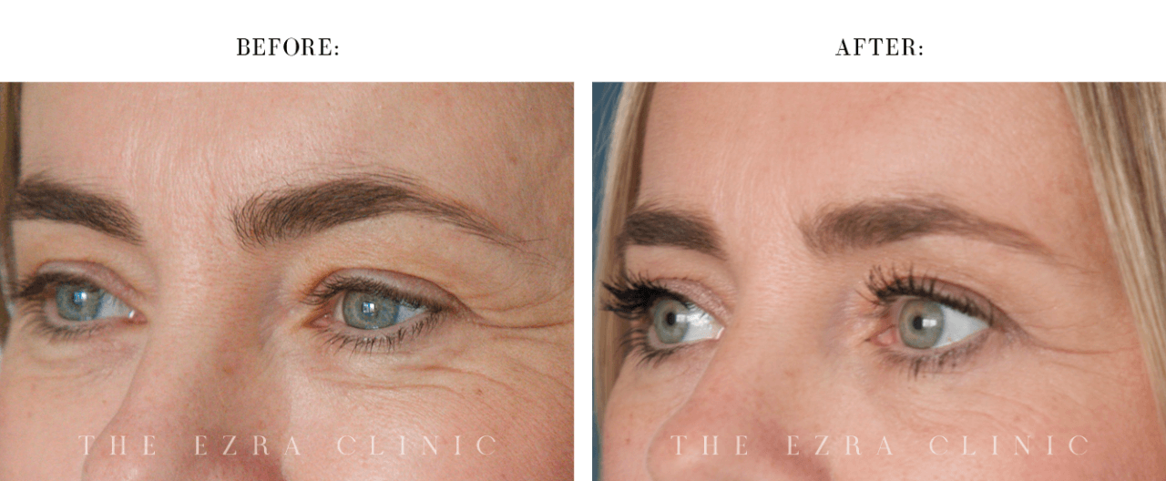 Eye rejuvenation before and after photos