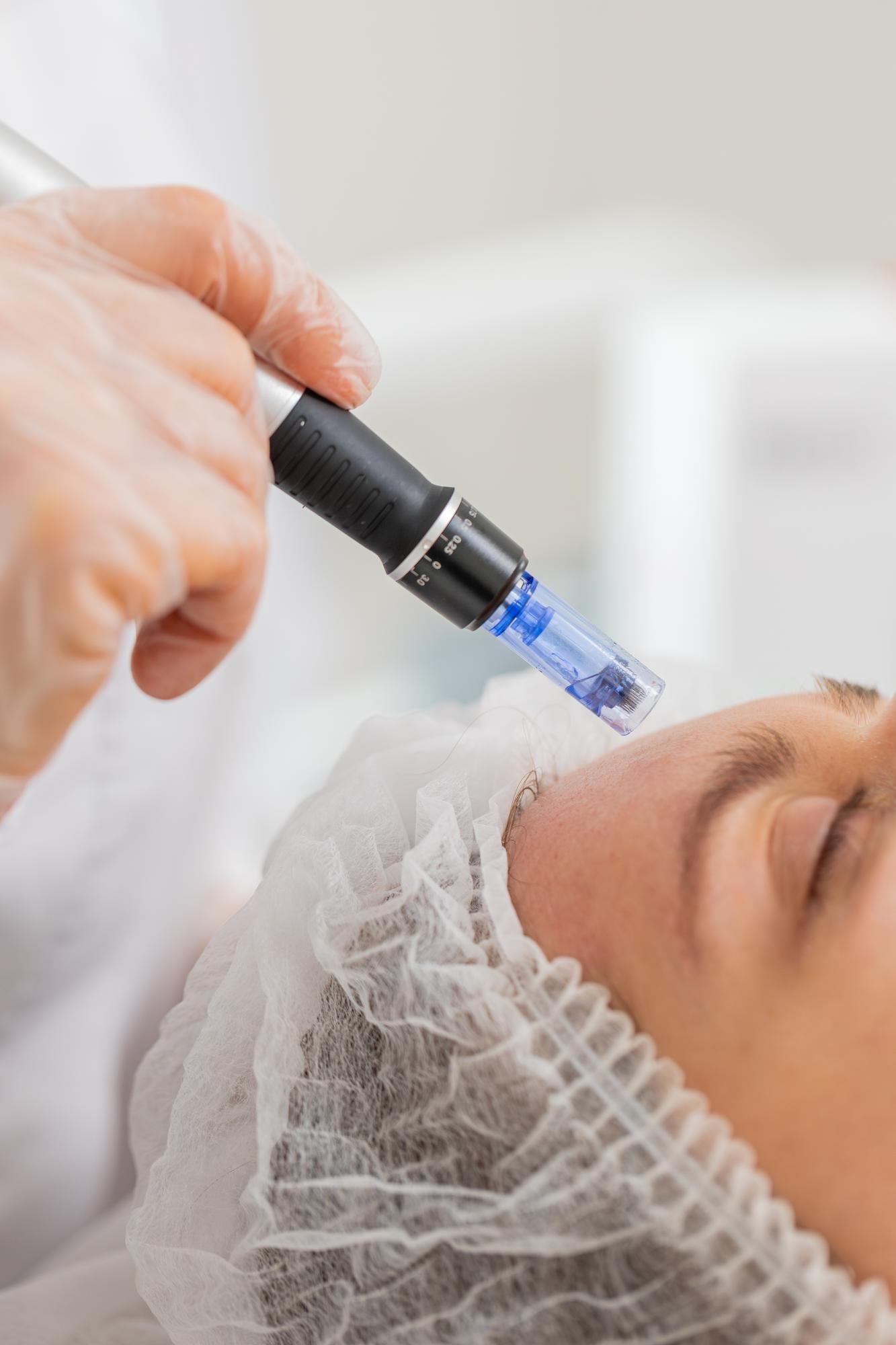 Aesthetician performing microneedling treatment on a patient’s face using a professional dermapen device.