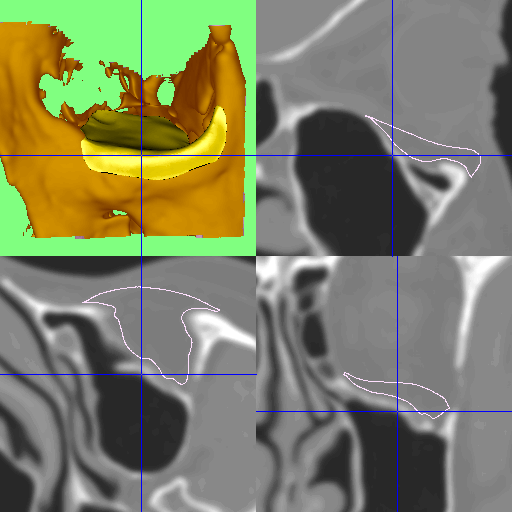 broken-eye-socket-scan