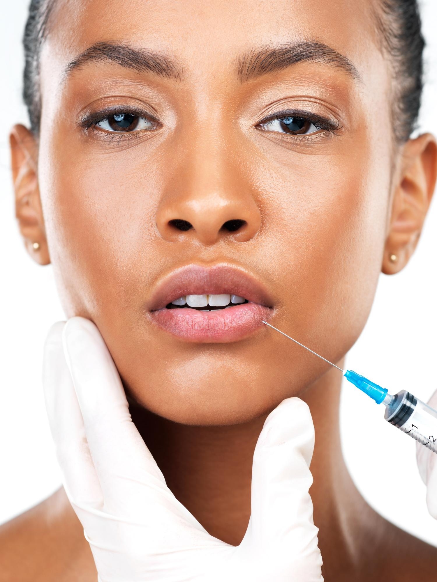 Close-up of a cosmetic professional preparing to inject dermal filler into a woman’s lips using a syringe.