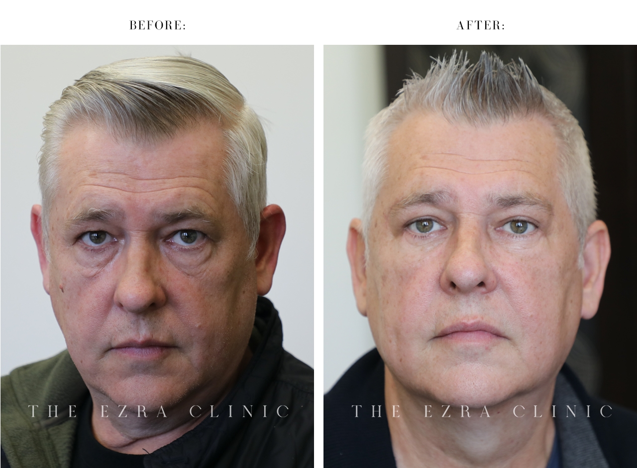 Male patient after blepharoplasty and midface lift with improved under-eye definition and a refreshed appearance