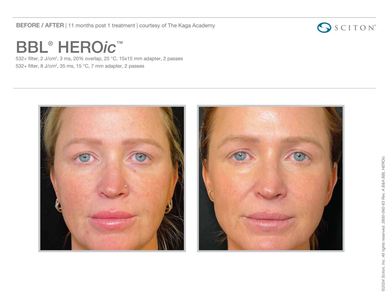 Before and after front-facing photos showing significant reduction in facial redness and pigmentation 11 months after one BBL HEROic treatment
