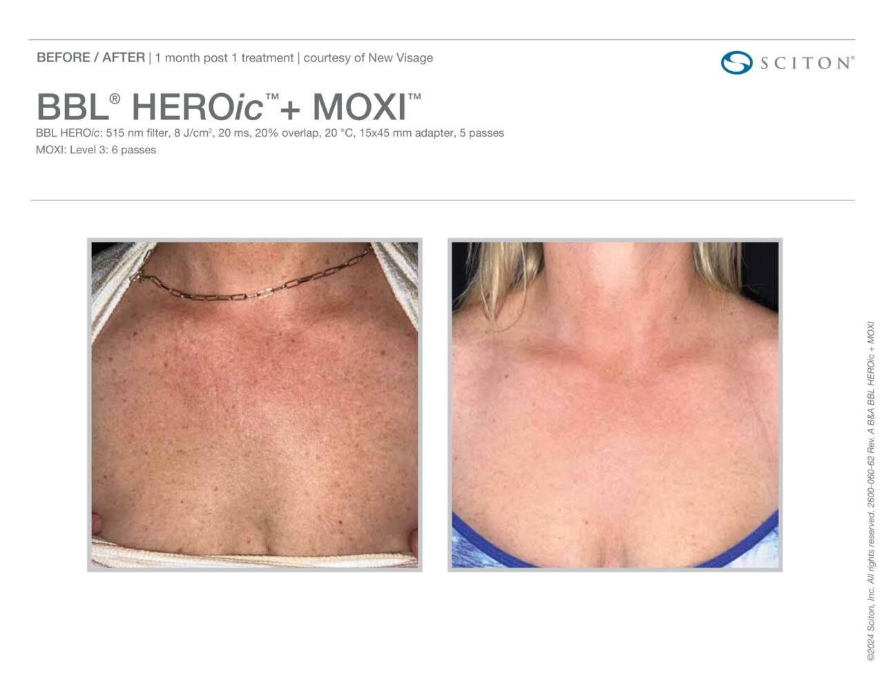 Before and after photos showing reduction in redness and sun damage on the chest and décolletage 1 month after one BBL HEROic + MOXI treatment