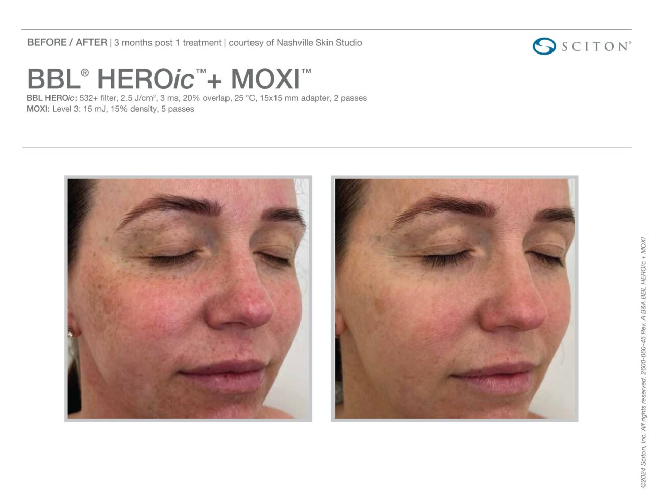 Before and after photos showing reduction in facial pigmentation and sun spots 3 months after one BBL HEROic + MOXI treatment