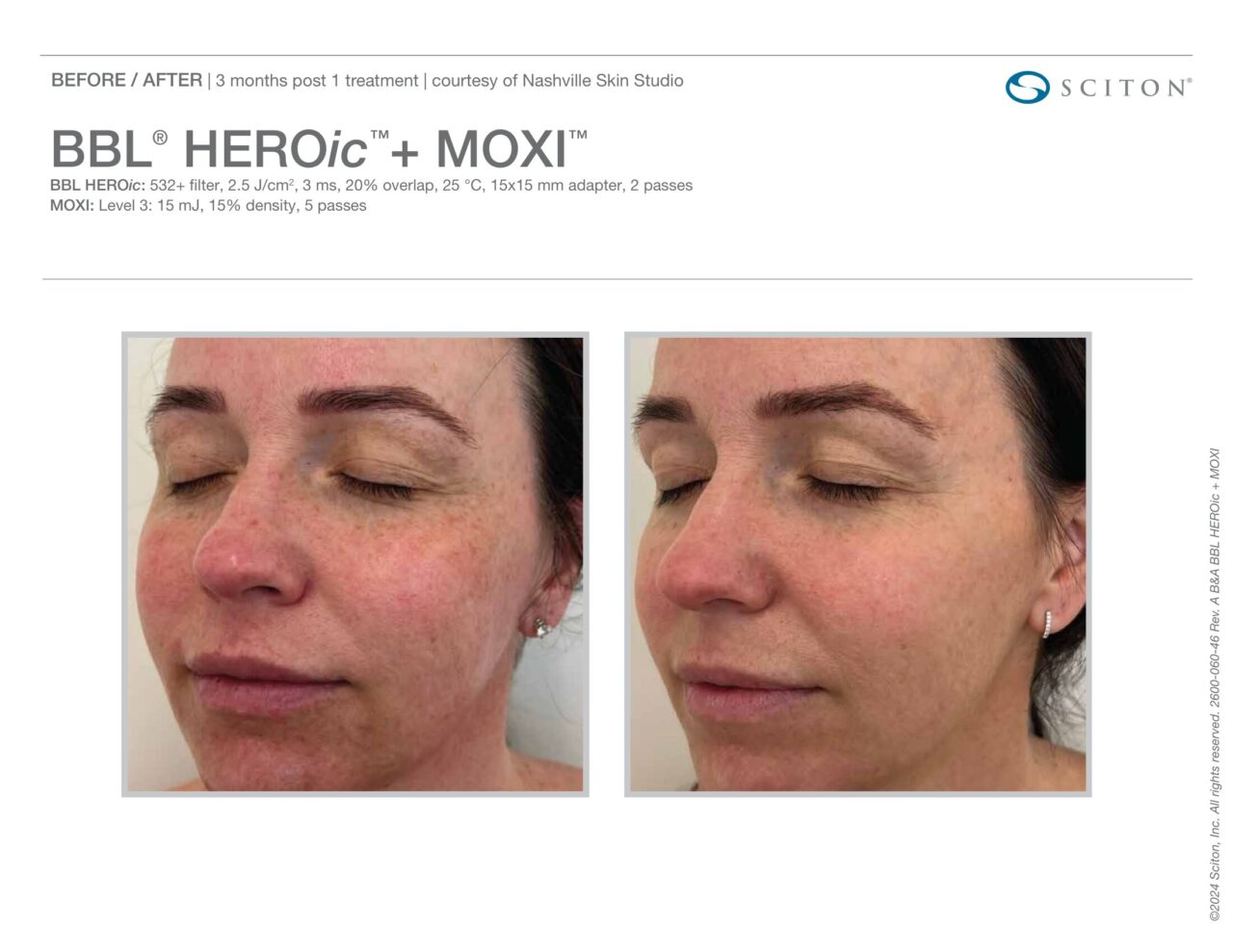 Before and after photos showing improvement in facial redness and skin tone 3 months after one BBL HEROic + MOXI treatment