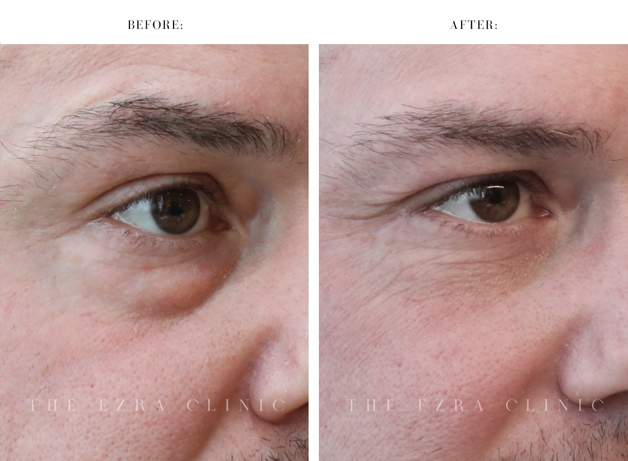 Male patient before and after bilateral lower lid blepharoplasty with fat repositioning and midface elevation showing reduced under-eye bags and a smoother lid-cheek junction