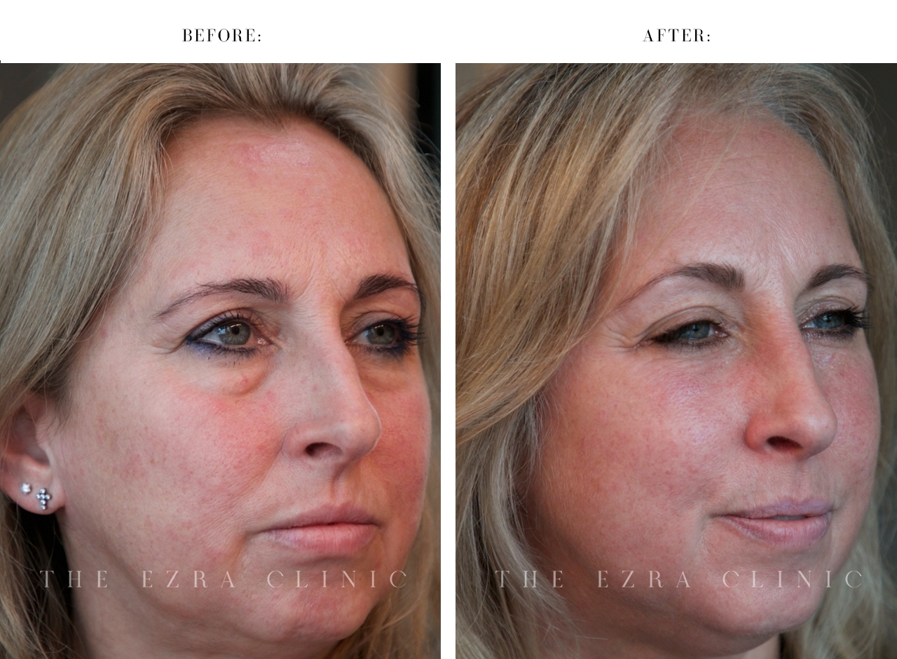 Female patient after lower eyelid surgery and midface lift with improved lid-cheek transition and correction of eye bag asymmetry