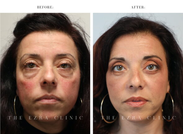Female patient before and after upper and lower blepharoplasty showing reduced under-eye bags, smoother eyelid contours and a more refreshed appearance