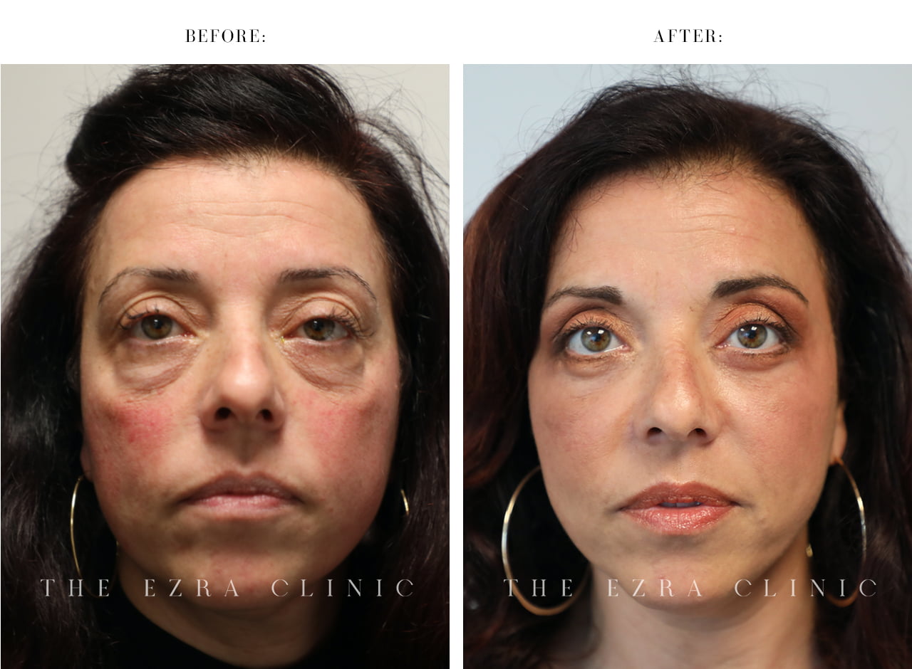 Female patient before and after upper and lower blepharoplasty showing reduced under-eye bags, smoother eyelid contours and a more refreshed appearance