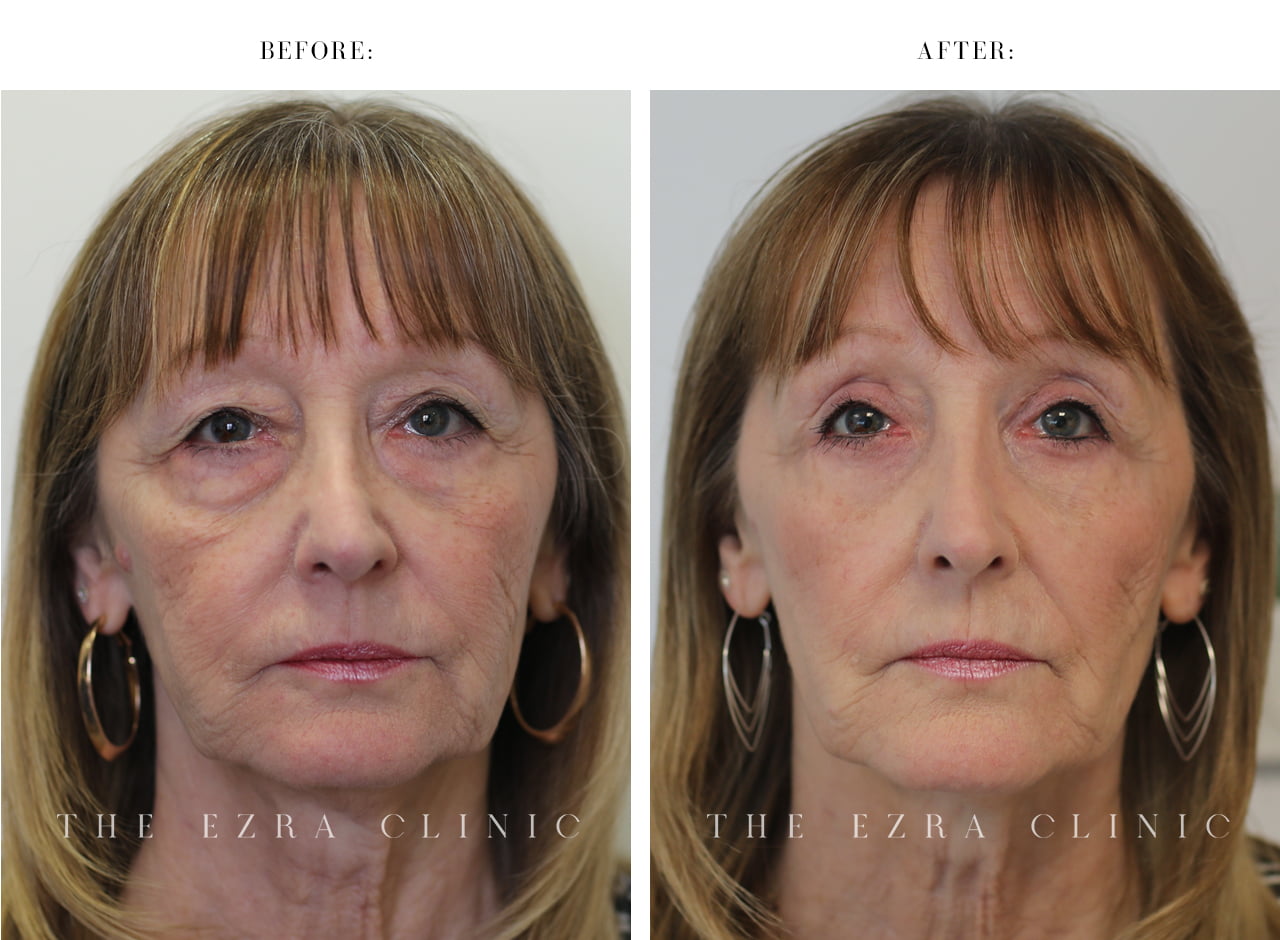 Upper and lower blepharoplasty results showing reduced under-eye bags, enhanced cheek volume and improved upper eyelid definition