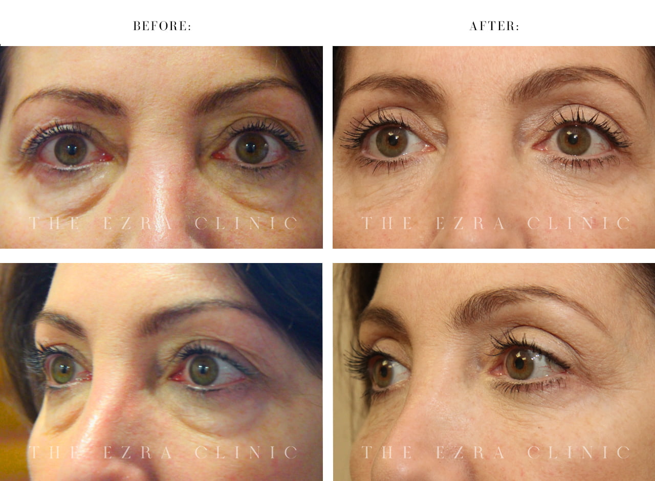 Lower blepharoplasty transformation showing correction of under-eye bags and improved lower eyelid definition