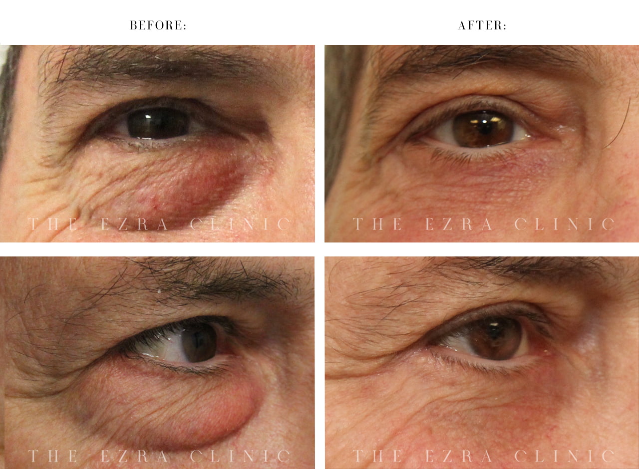 Lower blepharoplasty before and after showing significant reduction of under-eye bags and smoother lower eyelid contours in a male patient