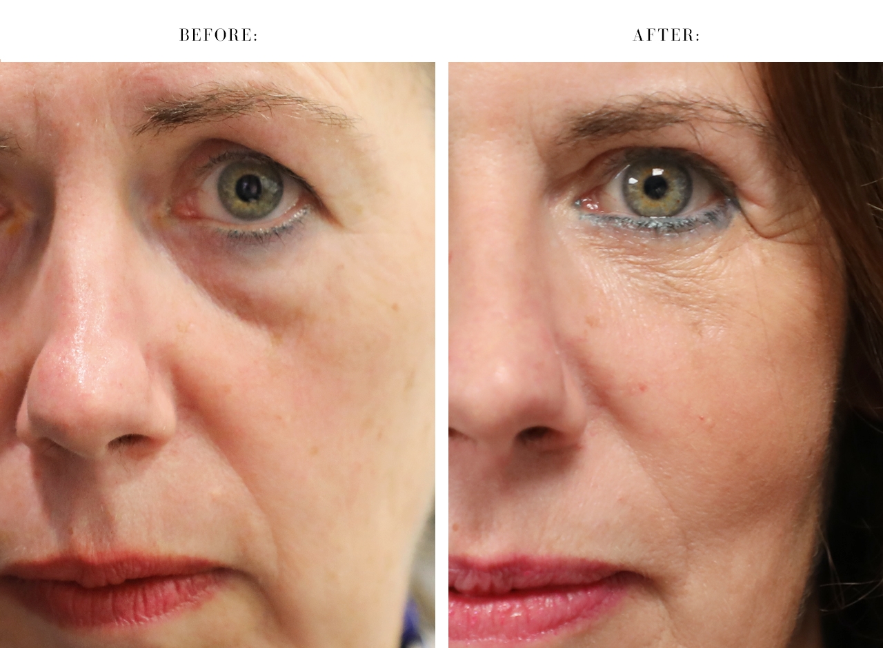 Female patient before and after lower lid blepharoplasty with midface lift and fat transfer showing reduced under-eye bags, restored cheek volume and a smoother lid-cheek transition