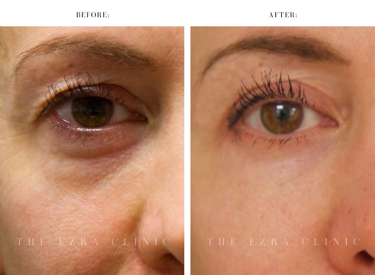 Female patient before and after lower lid blepharoplasty with midface lift and autologous fat transfer showing smoother under-eye contours, improved cheek volume and reduced facial hollowing