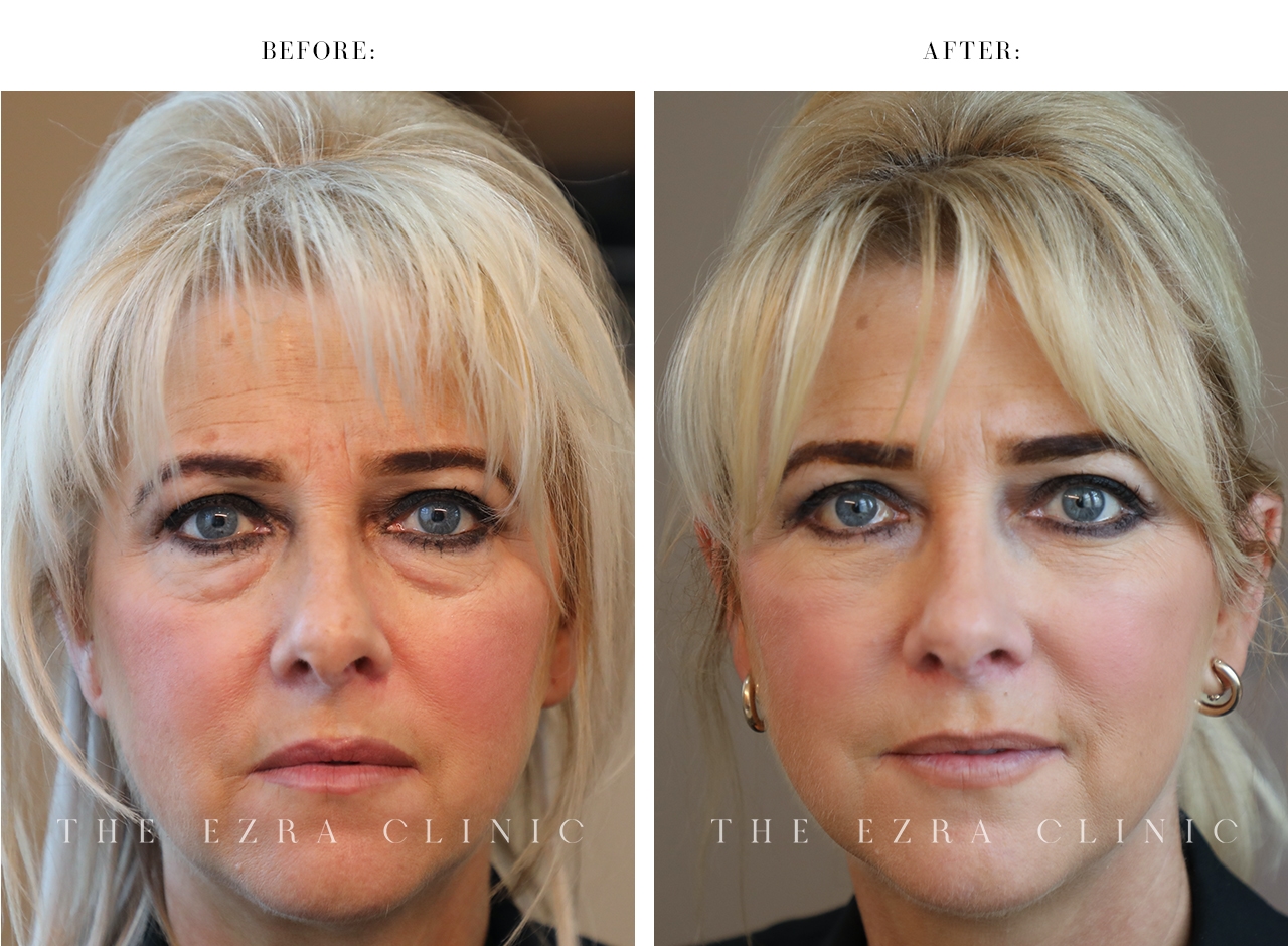 Female patient before and after lower eyelid blepharoplasty with fat repositioning showing reduced under-eye bags and a fresher, more rested appearance