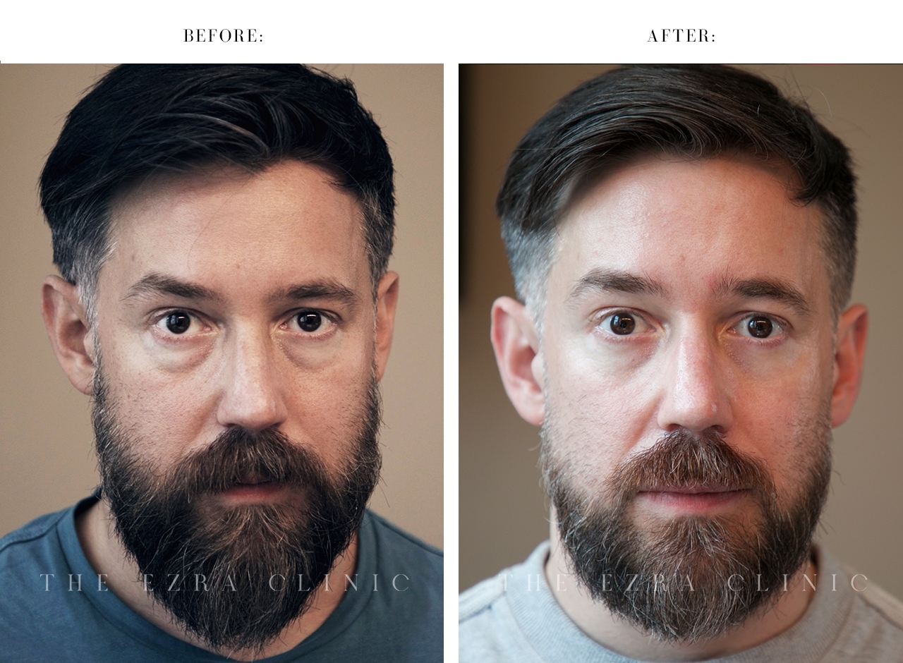 Before and after lower lid blepharoplasty with midface lift demonstrating correction of under-eye bag asymmetry and hollowing