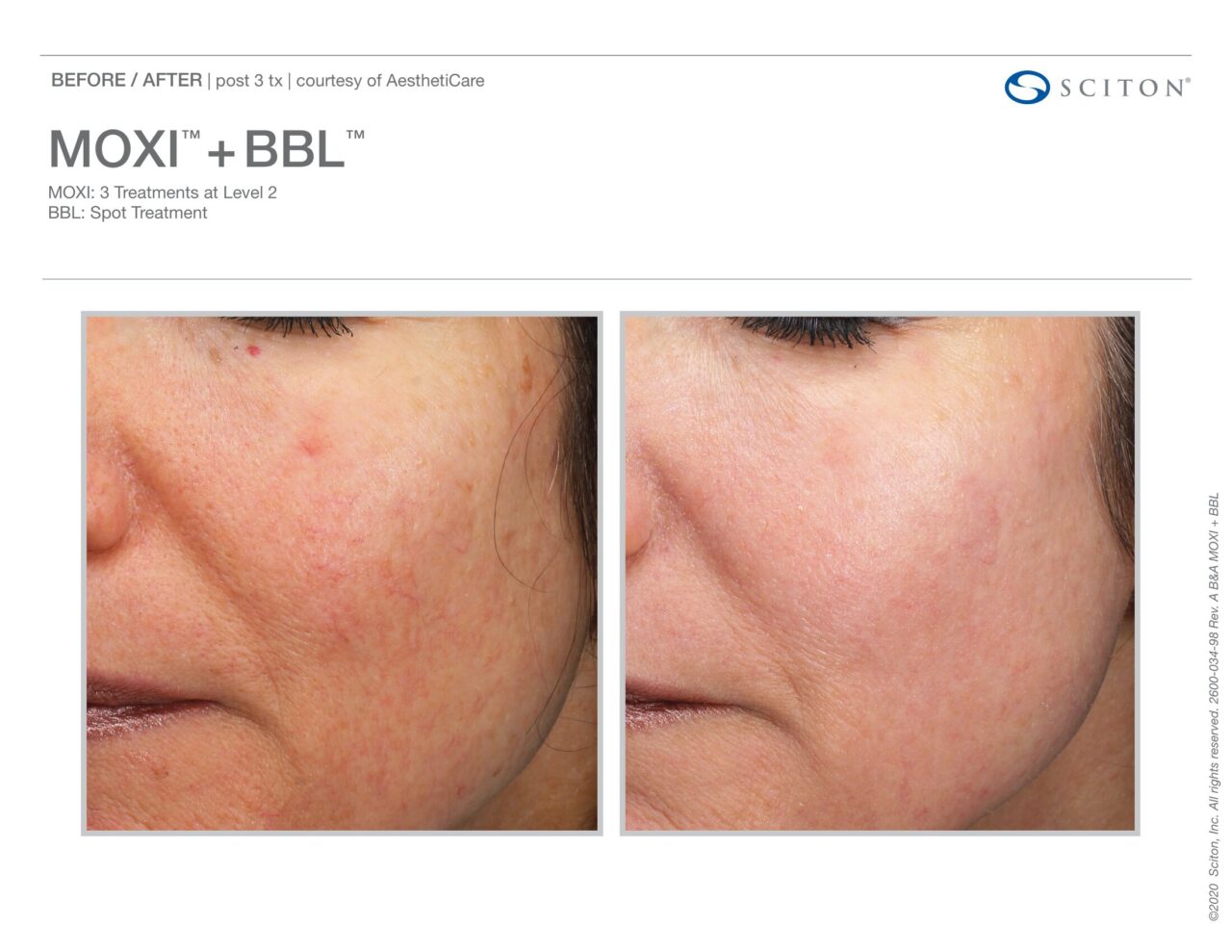 Alt text: Before and after close-up photos showing improvement in acne, skin texture, and tone after 3 MOXI + BBL treatments