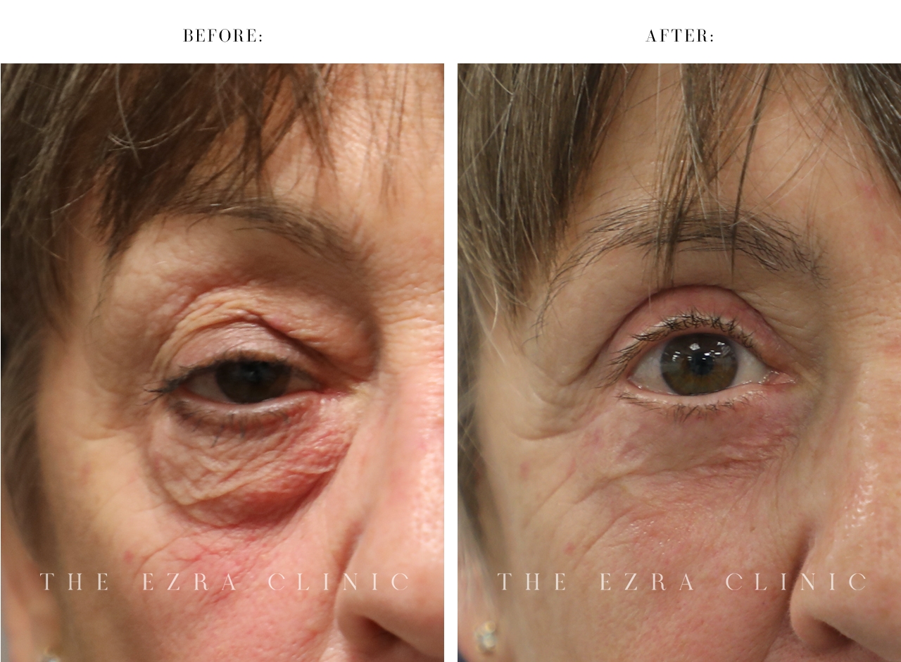 Female patient before and after ptosis surgery and blepharoplasty illustrating improved upper eyelid height and reduced lower eyelid fullness