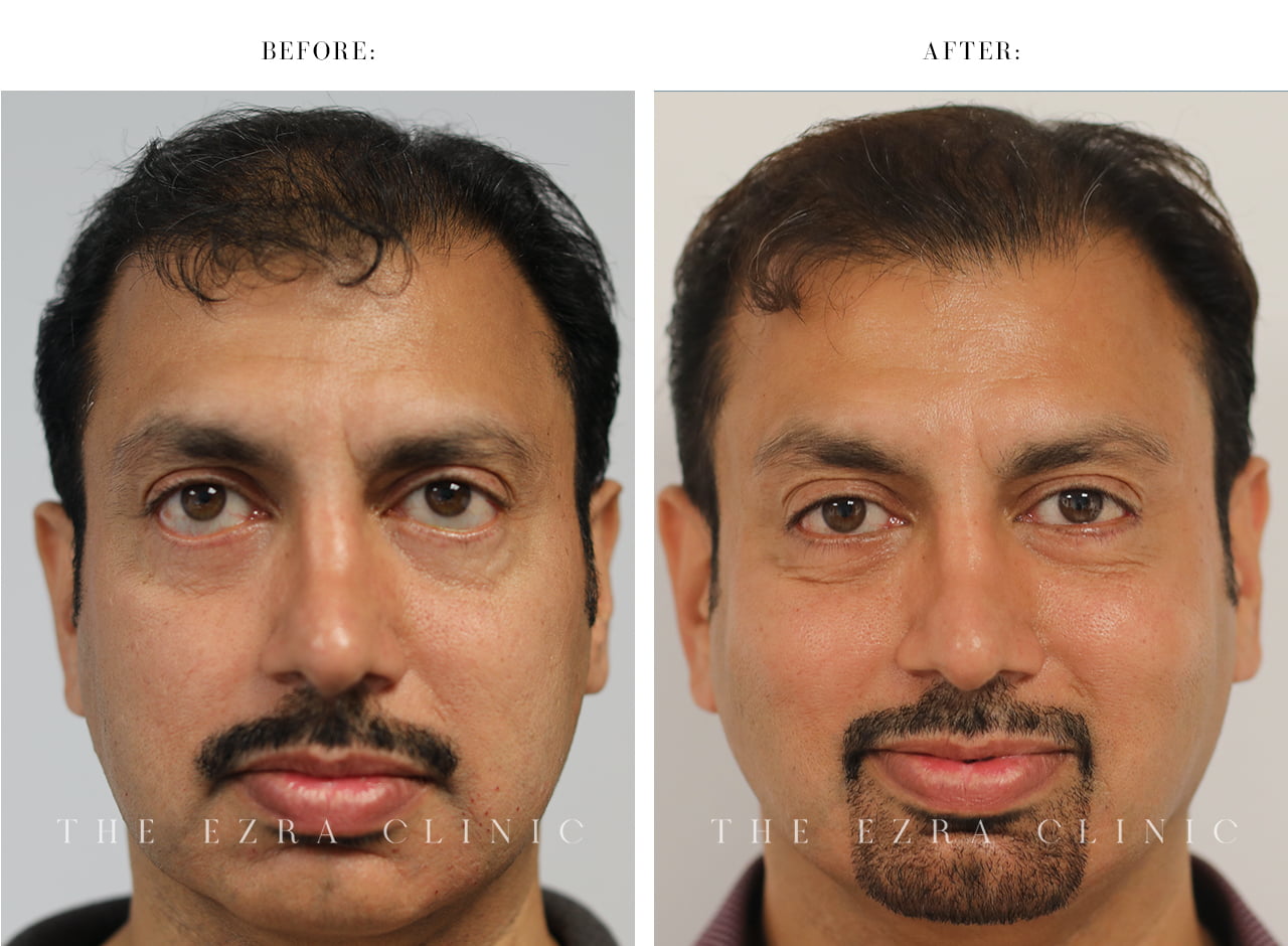 Male patient after revision lower eyelid surgery with restored eyelid position and improved eye symmetry