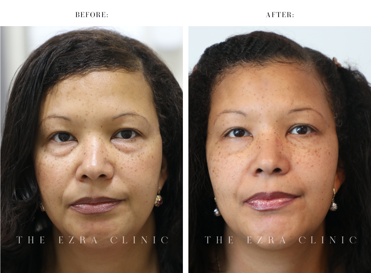 Female patient before and after transconjunctival lower blepharoplasty with fat redraping showing reduced under-eye bags and improved tear trough contours
