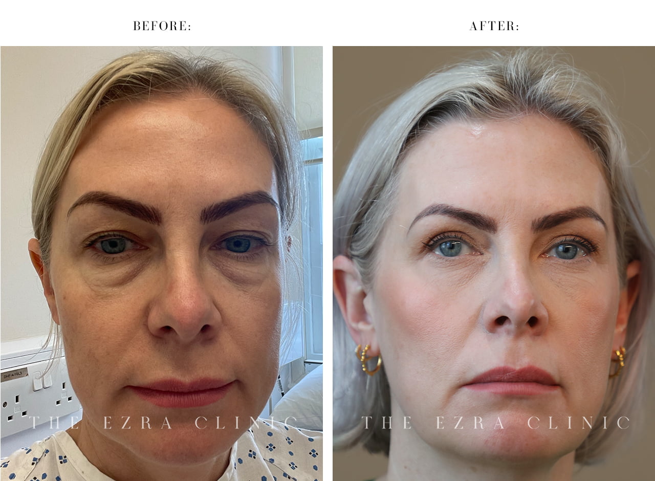 Before and after lower blepharoplasty with fat repositioning and midface elevation creating a refreshed under-eye appearance