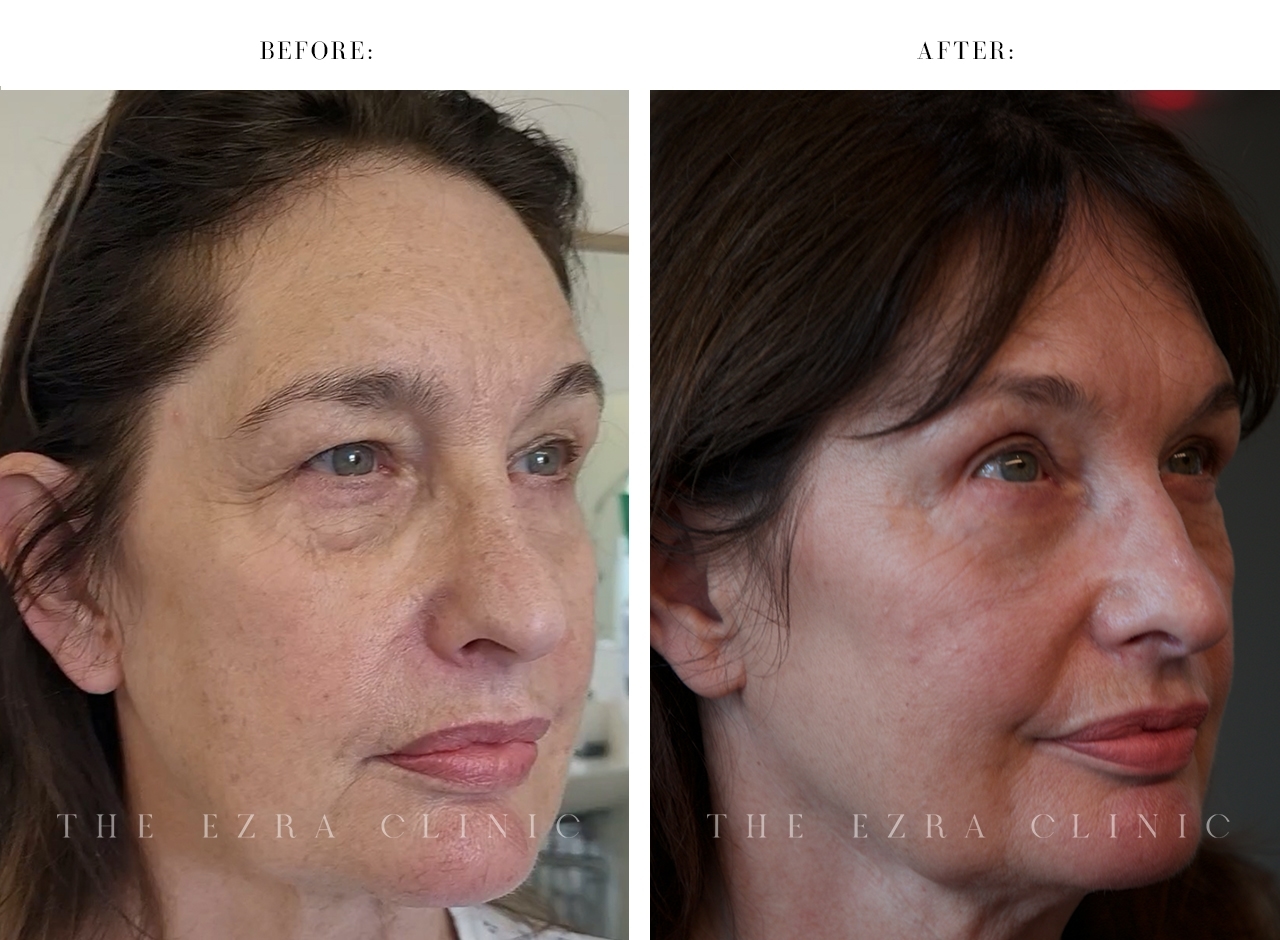 Woman patient after combined upper and lower blepharoplasty with fat repositioning and brow lift showing comprehensive eye rejuvenation
