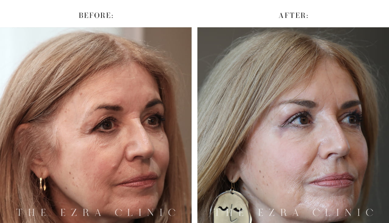Before and after bilateral upper lid blepharoplasty and direct brow lift demonstrating a more open eye appearance and improved brow position