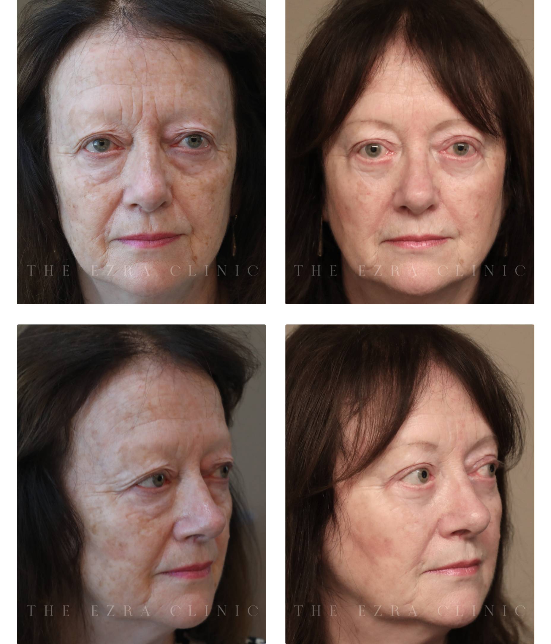 Female patient before and after upper and lower blepharoplasty with direct brow lift and midface elevation showing reduced eyelid hooding, correction of under-eye bags and improved eye contours
