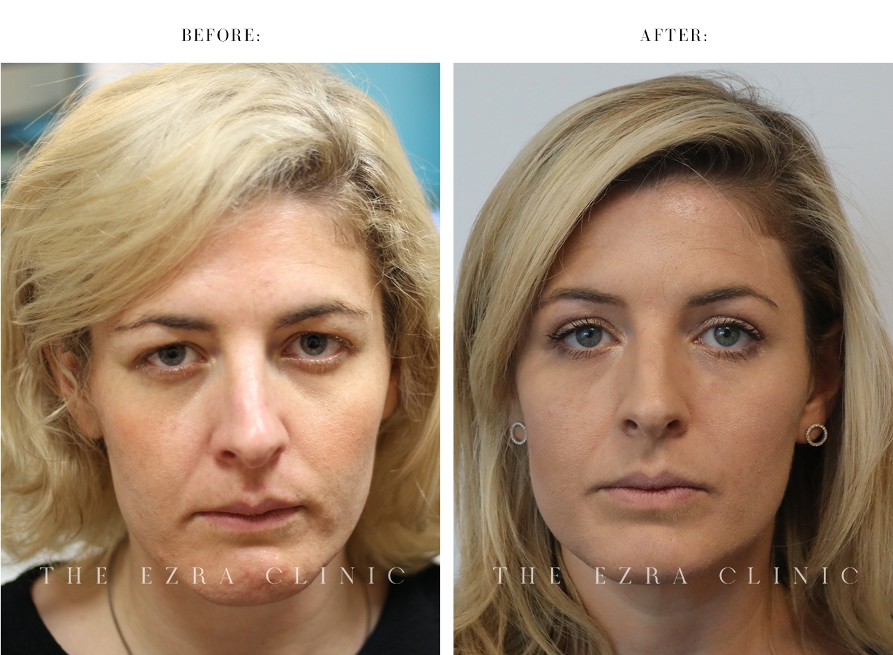 Before and after upper and lower eyelid surgery with internal browpexy demonstrating correction of eyelid heaviness and under-eye fullness