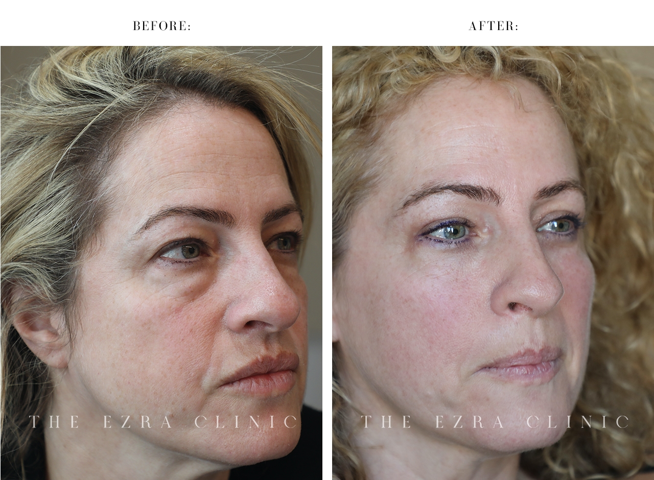 Before and after upper and lower eyelid surgery with internal browpexy demonstrating improved under-eye contours and brow support