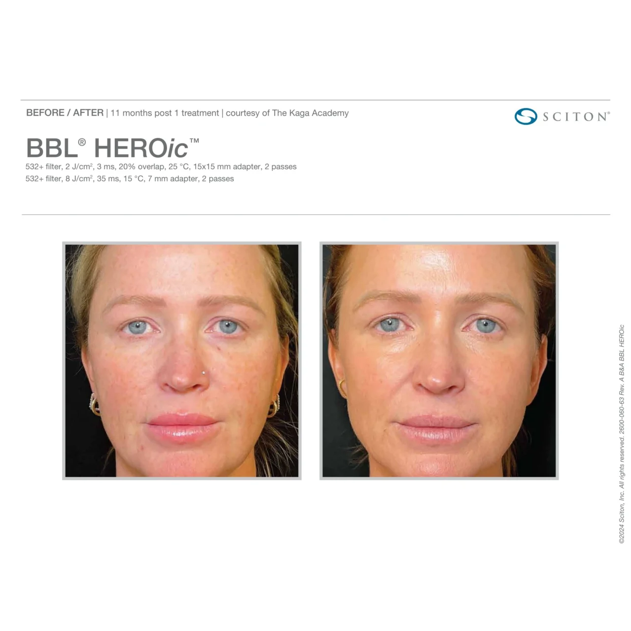 Before and after front-facing photos showing significant reduction in facial redness and pigmentation 11 months after one BBL HEROic treatment